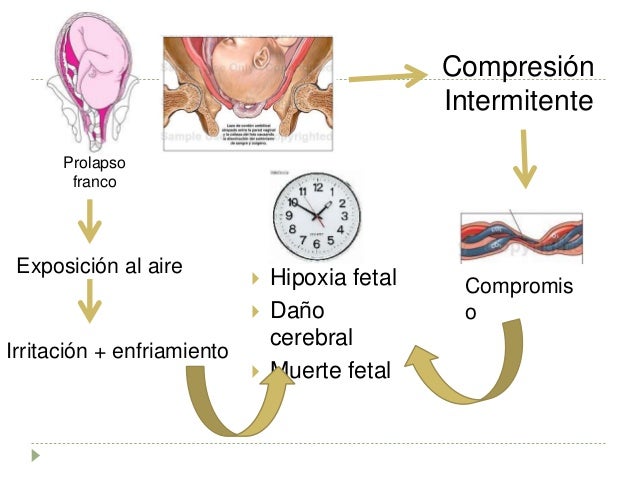 distocias de anexos fetales